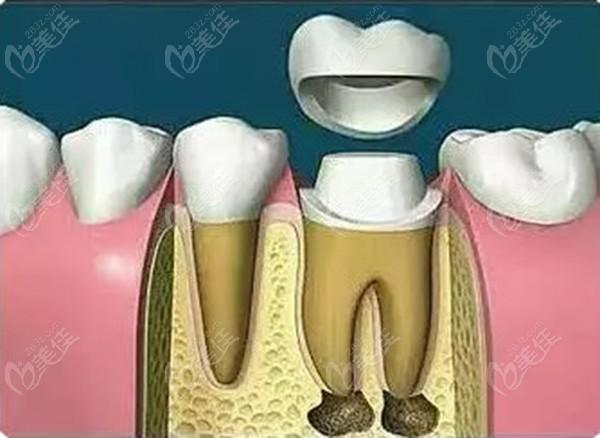 门牙如何根管治疗及门牙根管治疗多少钱一颗牙(门牙根管治疗多少钱一颗牙)
