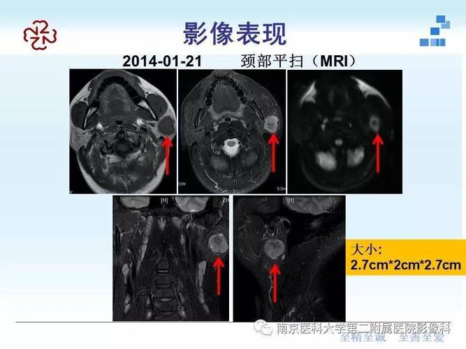 如何进行腮腺造影检查及相关视频演示(如何做腮腺造影检查视频)