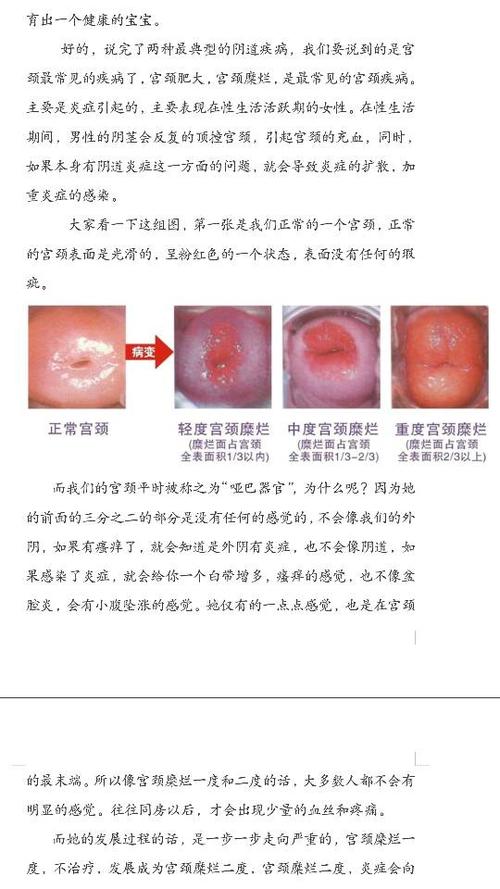 轻微宫颈糜烂如何治疗及轻微宫颈糜烂怎样治疗(轻微宫颈糜烂怎样治疗)