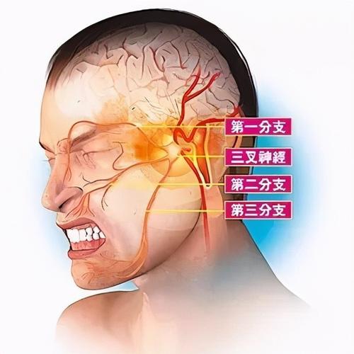 三叉神经痛如何发病及其病因分析(三叉神经痛如何发病的)