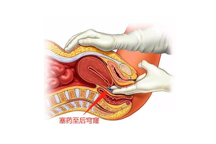 如何正确插入宫颈及如何往宫颈口塞药的方法与注意事项(怎么往宫颈口塞药)