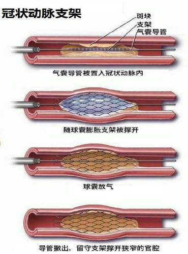 冠脉穿孔如何制作带膜支架？制作带膜支架视频教程及健康知识解析(冠脉穿孔 如何 制作带膜支架视频)