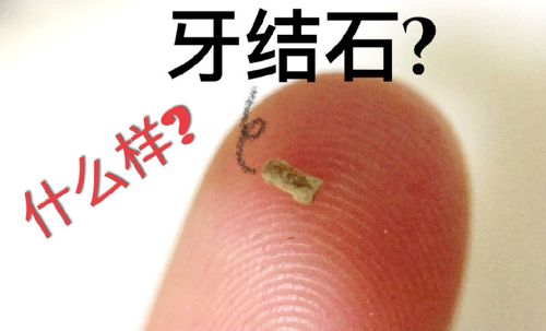 快速清除牙石的方法有什么？如何去掉牙石