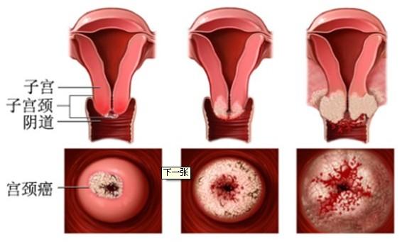 宫颈癌初期怎么治疗？子宫癌早期如何治疗
