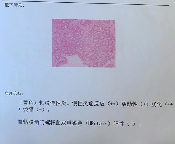 慢性轻度萎缩性胃炎伴轻度肠化能治愈吗？中度慢性萎缩性胃炎伴肠化如何治疗