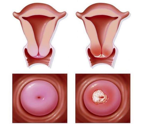 宫颈口的小白点是怎么回事？宫颈白斑如何治疗