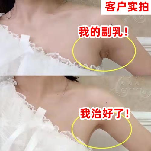 腋窝处有副乳应该怎么消除？如何去除腋下副乳