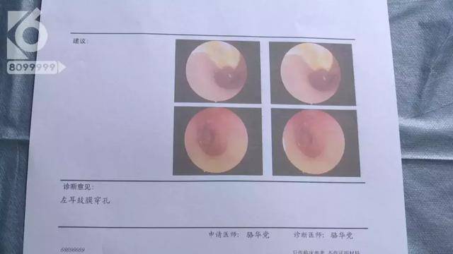 耳膜穿孔司法鉴定的内容和程序有哪些？如何检测耳膜穿孔大小