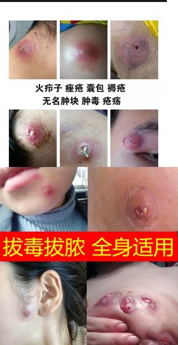 疖子破了但是里面还是硬的怎么办？疖肿好后硬块如何去除