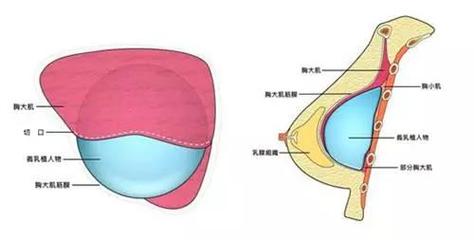 隆胸与自然胸的视觉区别？如何分辨假乳房和真乳房