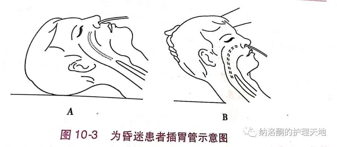 昏迷病人插胃管怎样喂食？如何自己插胃管