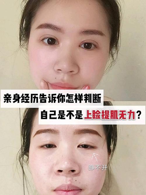 眼睛小适合哪种双眼皮？提上睑肌肌力如何测定