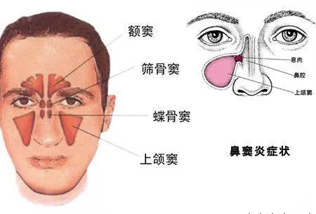 鼻窦炎严重吗？如何判断鼻窦炎程度