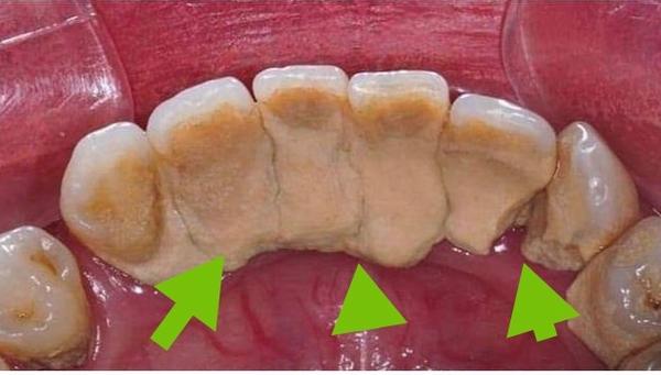 牙结石怎么去除好？自己如何去除牙结石