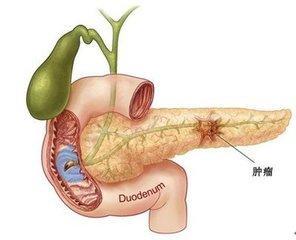 胰腺癌如何介入治疗？胰腺手术胰瘘如何补救