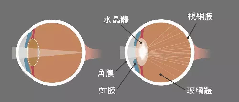 眼睛晶状体浑浊怎么办？如何恢复晶状体