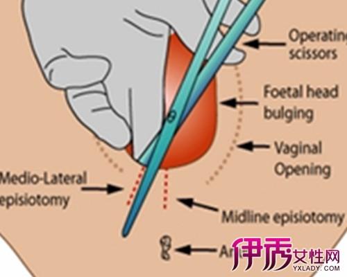 产妇侧切伤口多久才能愈合？侧切伤口如何恢复