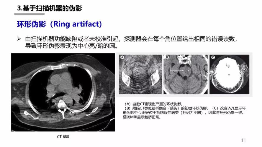 联影40排ct的优缺点？胸 片伪影如何鉴别