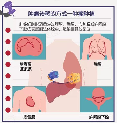 什么是癌症的转移灶谢谢？如何确定癌症转移