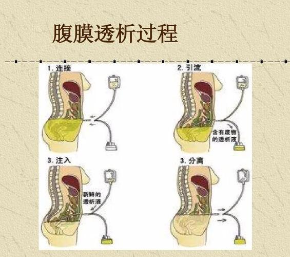 腹膜透析好还是血液透析好？如何腹膜透析