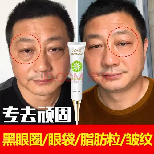 为什么眼袋发黑，怎么去除黑眼袋？如何去黑眼圈眼袋