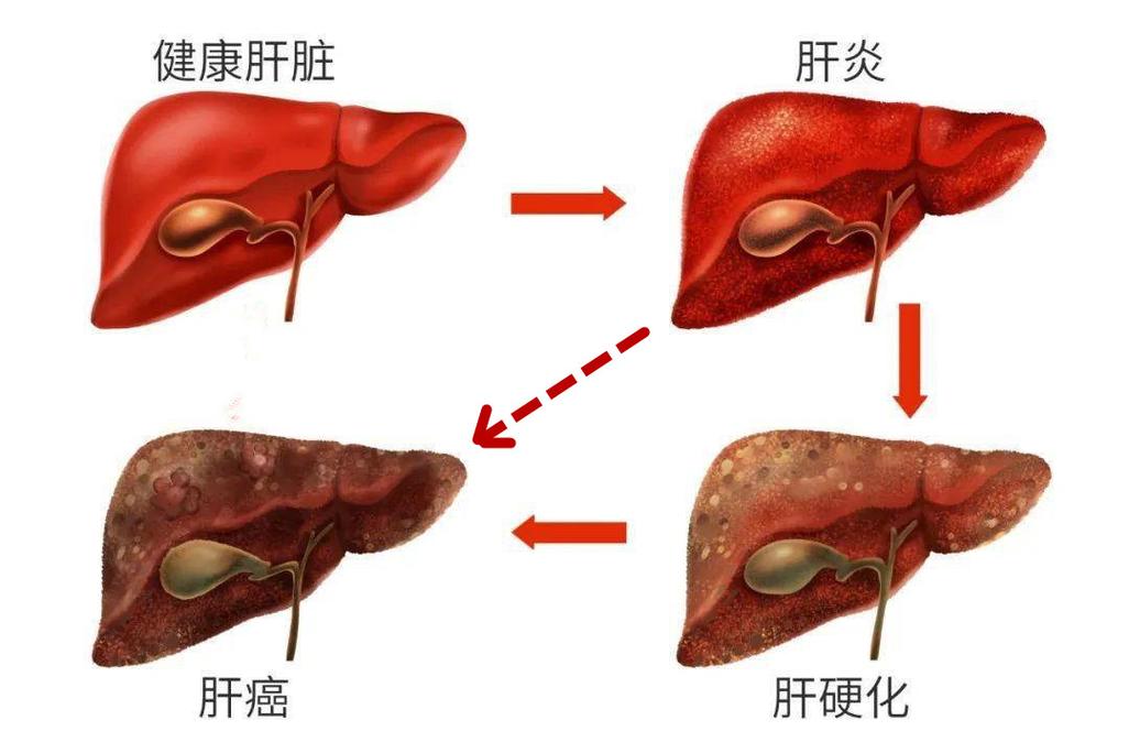 肝癌是怎么得的呢？肝癌如何引起