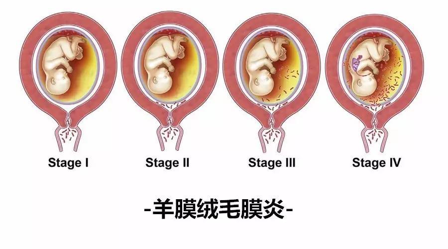 胎膜分几级？如何判断羊膜破裂