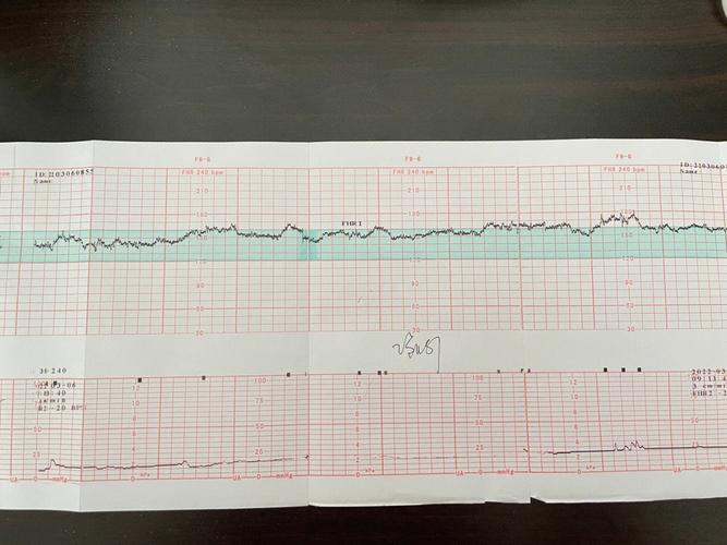 胎心监护是指什么？如何看胎心监测图