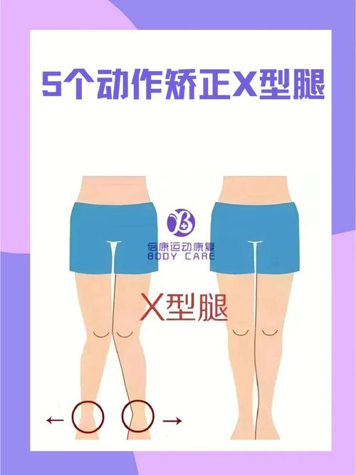 快速矫正X型腿的方法是什么？x型腿如何矫正