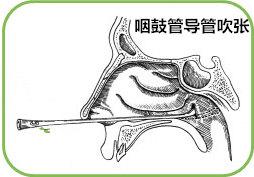 咽鼓管吹张法是什么？咽鼓管堵塞如何治疗