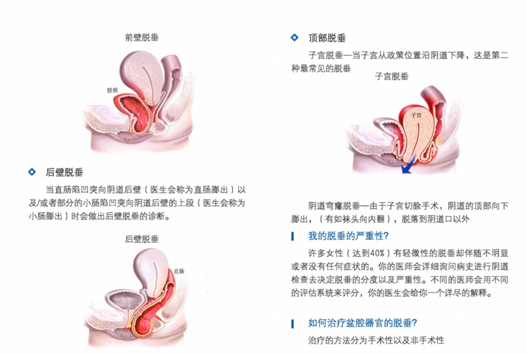 子宫下垂怎么办才能恢复好？如何治疗子宫下垂