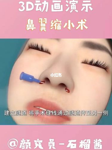 如何把鼻翼缩小？如何使鼻翼变小