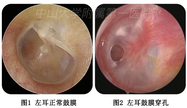 耳鼓膜塌陷了怎么办？耳膜内陷如何治疗