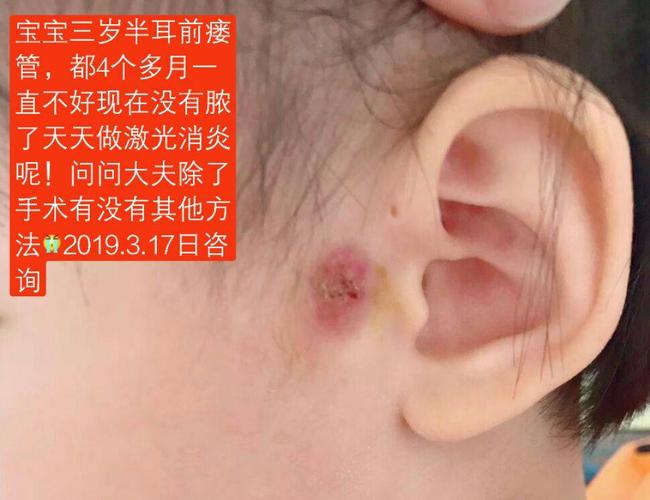 两岁小孩耳前瘘管发炎怎么消肿？耳前瘘管发炎如何消肿