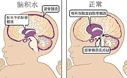 小孩脑积水有什么症状的啊？宝宝有一岁多了？如何检查胎儿脑积水