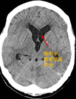 怀孕五个月胎儿脑积水怎么办，脑积水的治疗方法是什么？怀孕后胎儿脑积水如何办