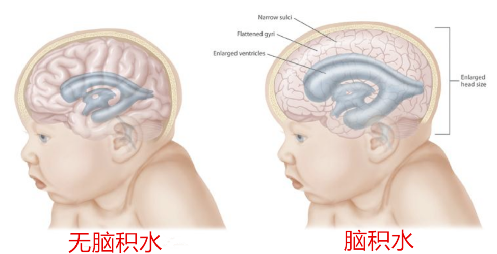 脑积水如何造成的？脑积水是如何引起的