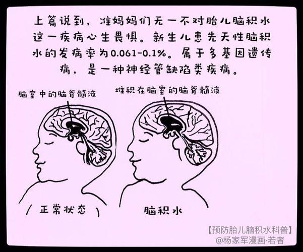 脑积水不做分流手术,有没有更好的办法？孕妇如何预防胎儿脑积水