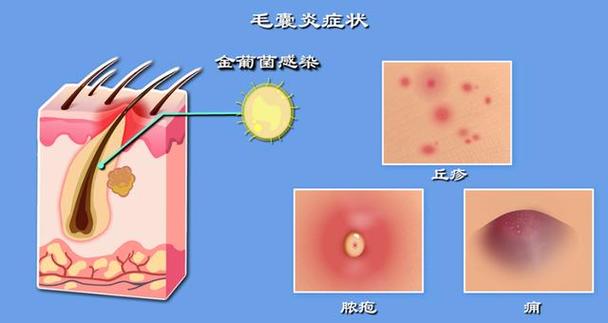 毛囊炎怎么能治好？如何根治毛囊炎