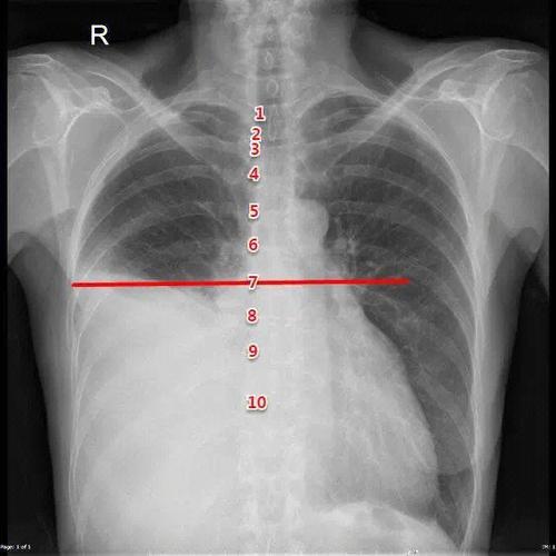 ct上如何看胸腔积液？x线胸片如何定量胸腔积液