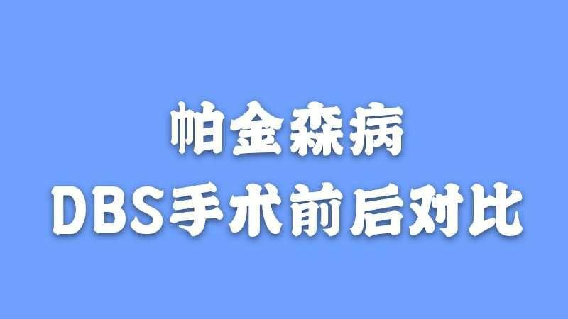 湖北省帕金森手术费用能报销多少？dbs手术效果如何啊