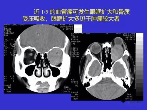 眼睛有问题做CT能检查出来吗？如何阅读眼眶ct