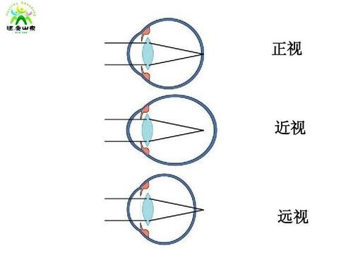 远视的原理？近视和远视是如何产生的