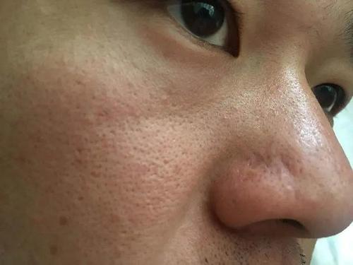 角质层过厚怎么办？角质层薄如何清洁毛孔