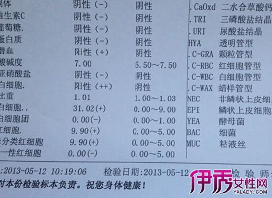 尿检能检查出淋病吗？淋病咽炎如何做涂片