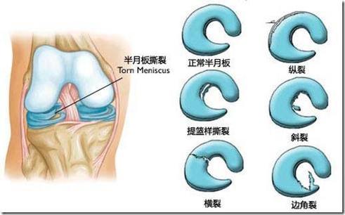 半月板损伤怎么治疗比较好？如何治疗好半月板后角损伤