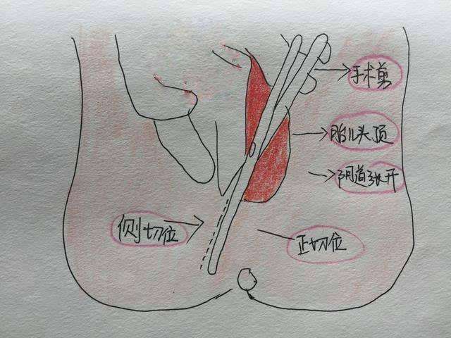 分娩撕裂伤口怎么办？顺产撕裂如何快速恢复