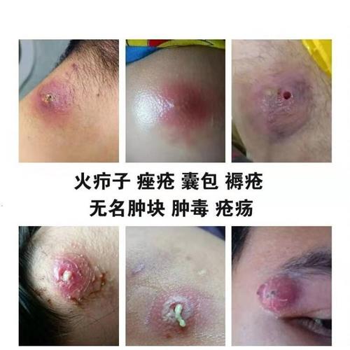 青春痘留下的硬块怎么消除？如何治疗硬结性毛囊炎