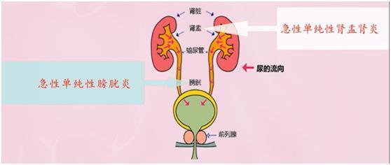 尿道炎是什么原因引起的？如何引起尿道炎