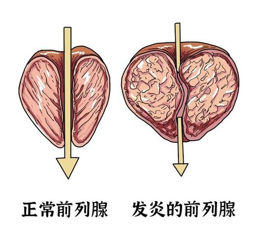 充血性前列腺炎怎么治呢？如何缓解前列腺充血